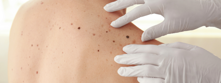 Seborrheic Keratosis Symptoms And Treatments 